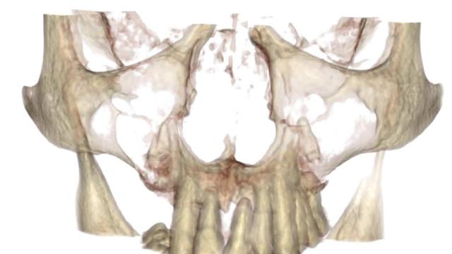 Immagine 3D ricavata dalla TaC del paziente che rivela una situazione di poco osso dovuta a grave parodontite.