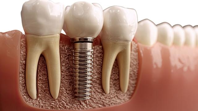 cover implantologia a carico immediato