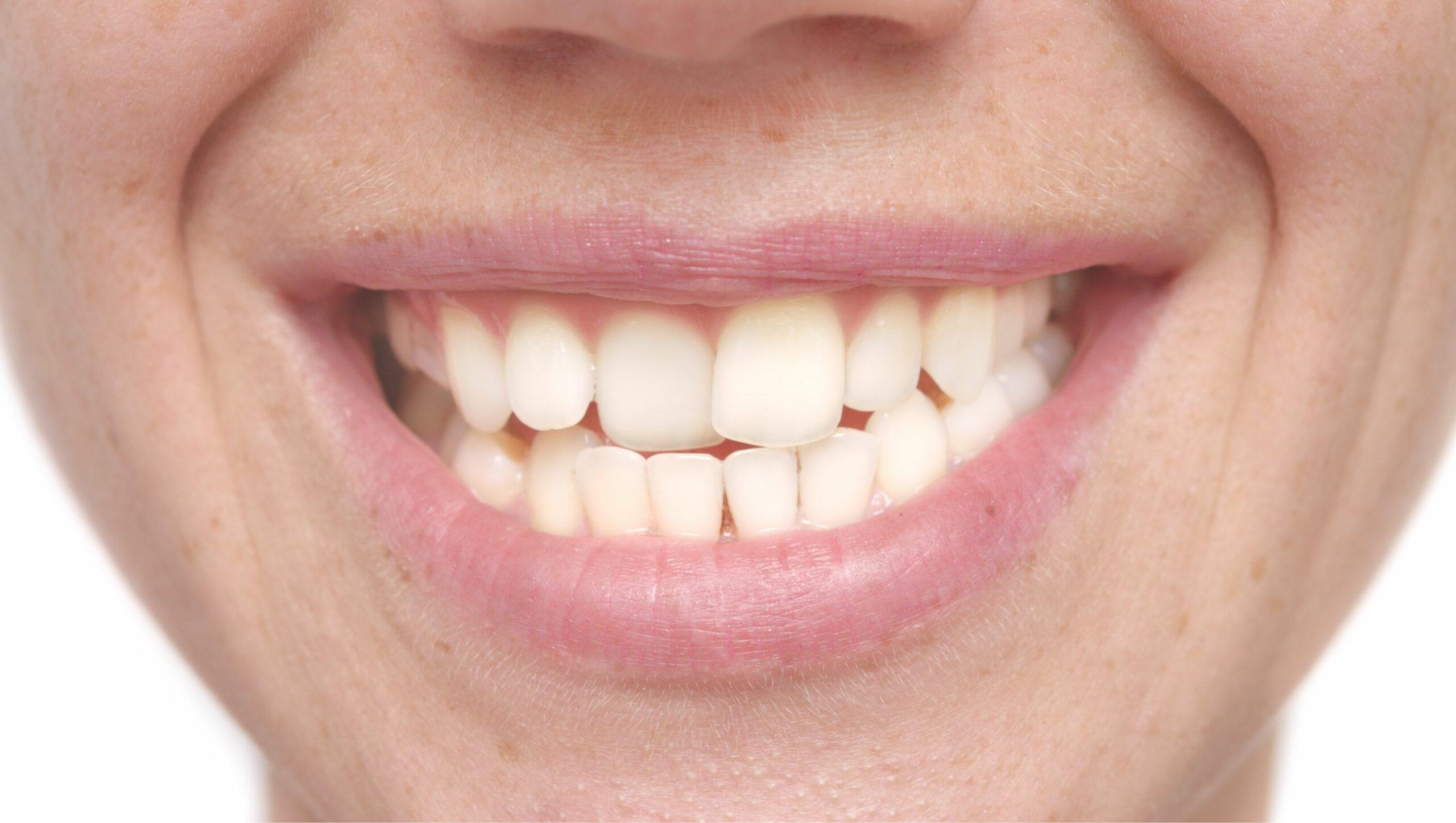 Denti storti negli adulti: cause, problemi e soluzioni
