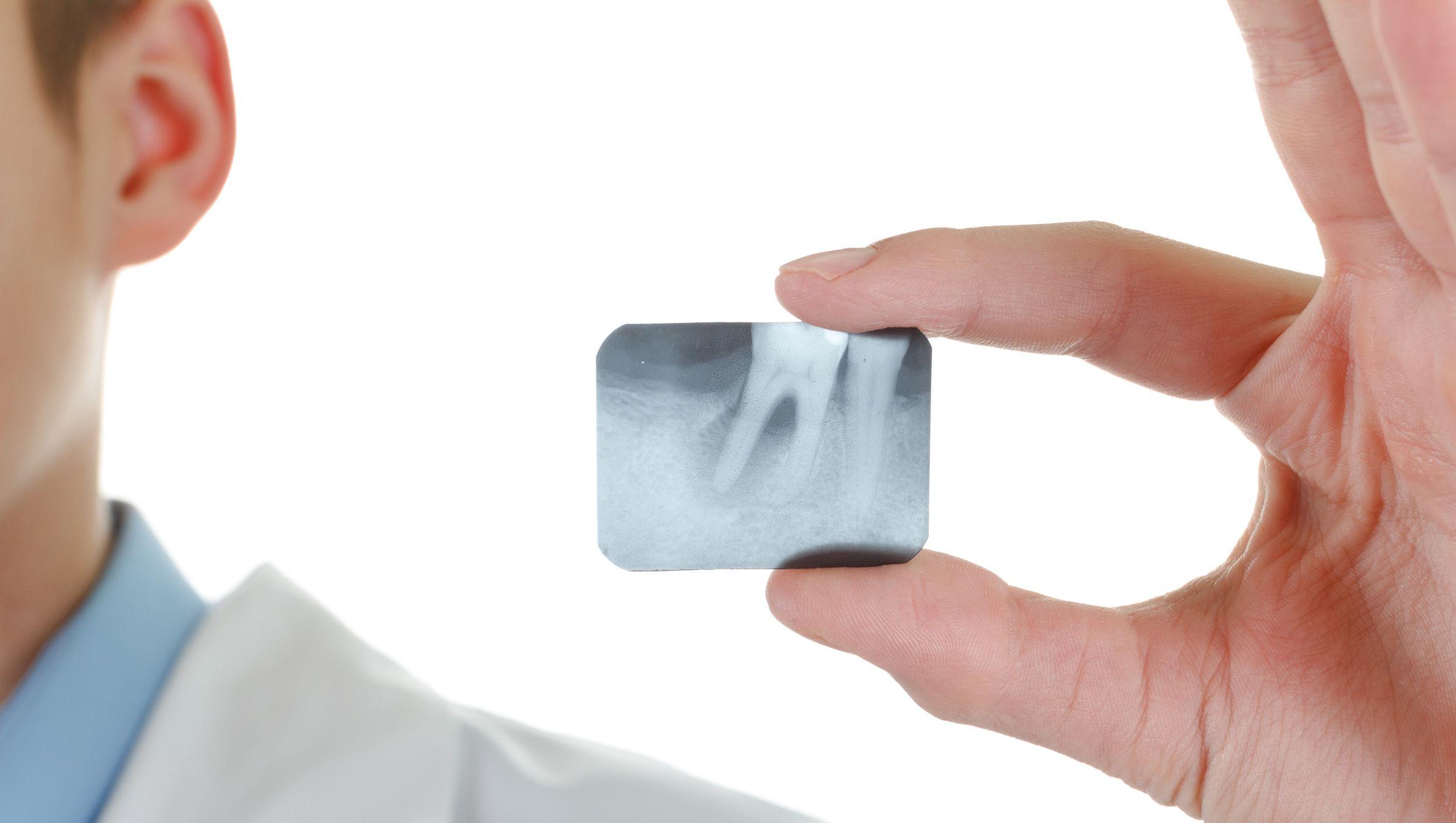 Parodontite: sintomi, cause, rimedi