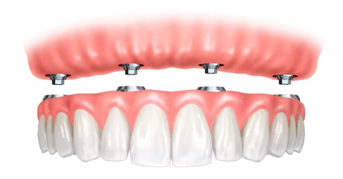 Impianti Dentali con Gengiva Finta