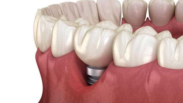 perimplantite