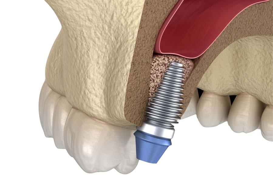 poco osso denti