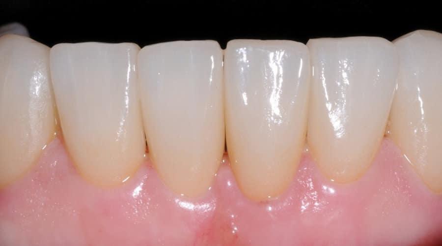 faccette dentali dopo il trattamento