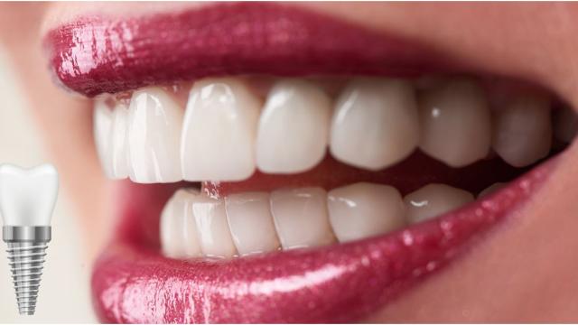 Cover implantologia dentale in aree estetiche