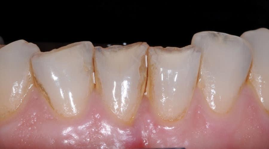 faccette dentali prima del trattamento