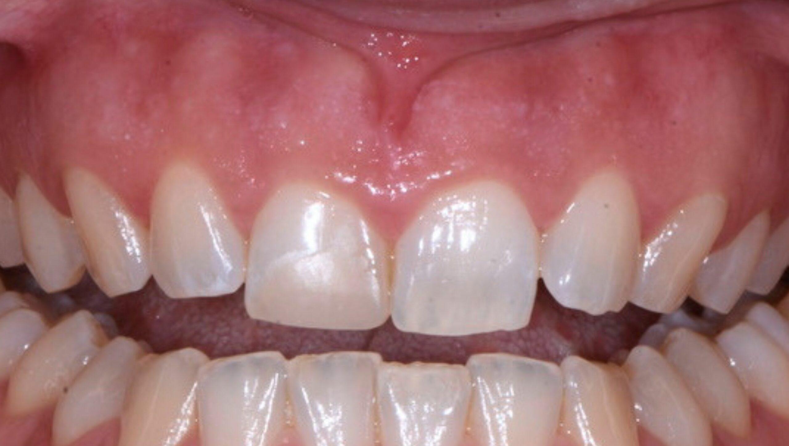 caso clinico faccette dentali paziente 10 prima