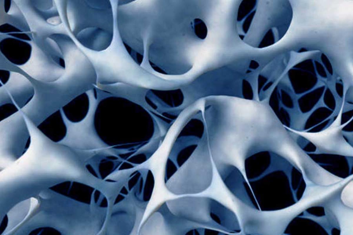 Osteoporosi dentale