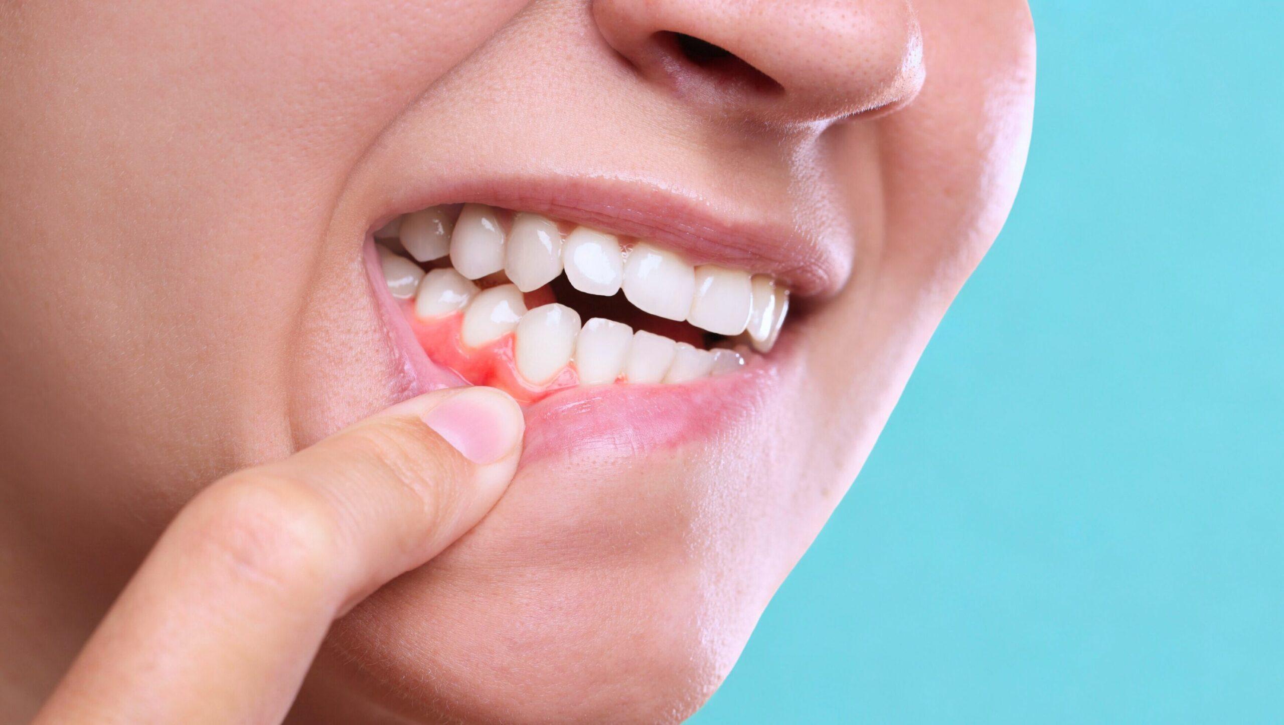 Gengive gonfie: cause, sintomi, rimedi e prevenzione