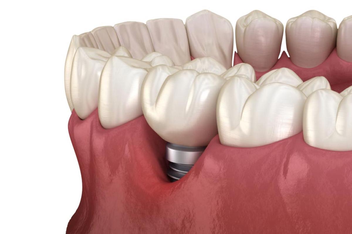 Perimplantite: cause e rimedi