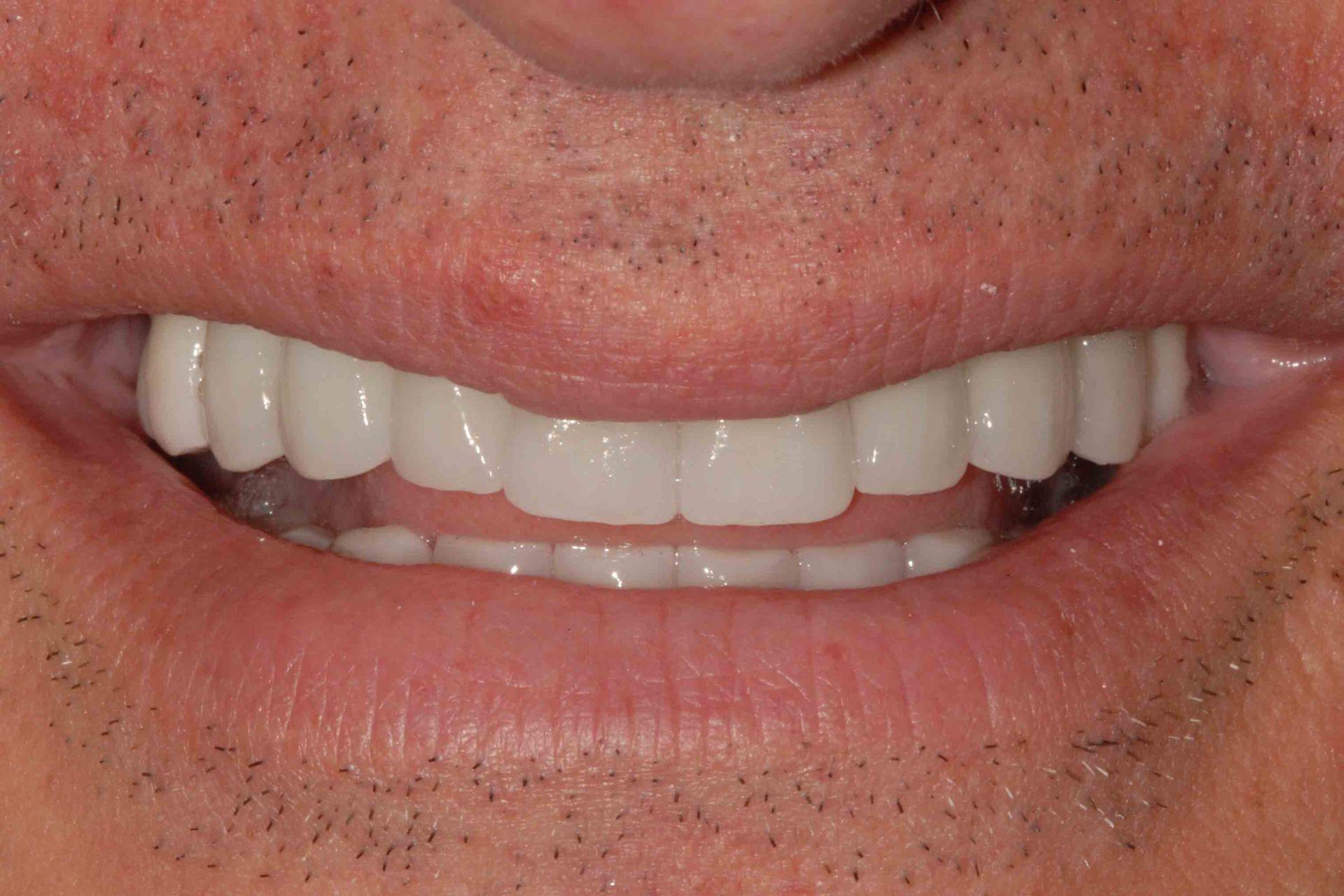 sorriso finale