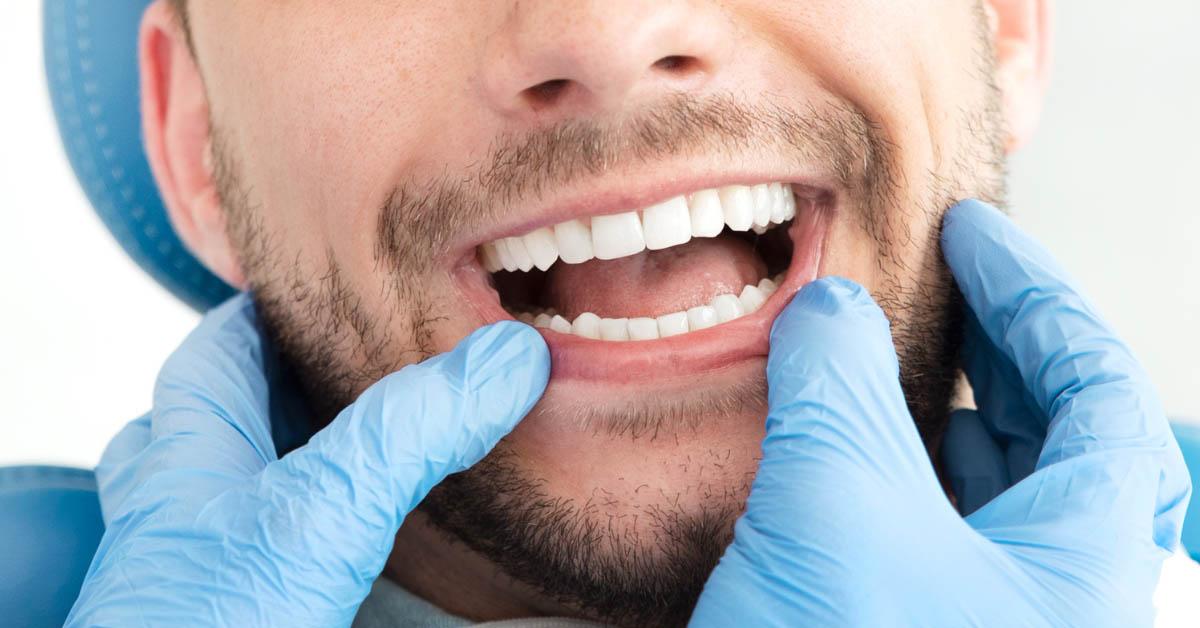 Malocclusione Dentale: Come Riconoscerla e Trattarla