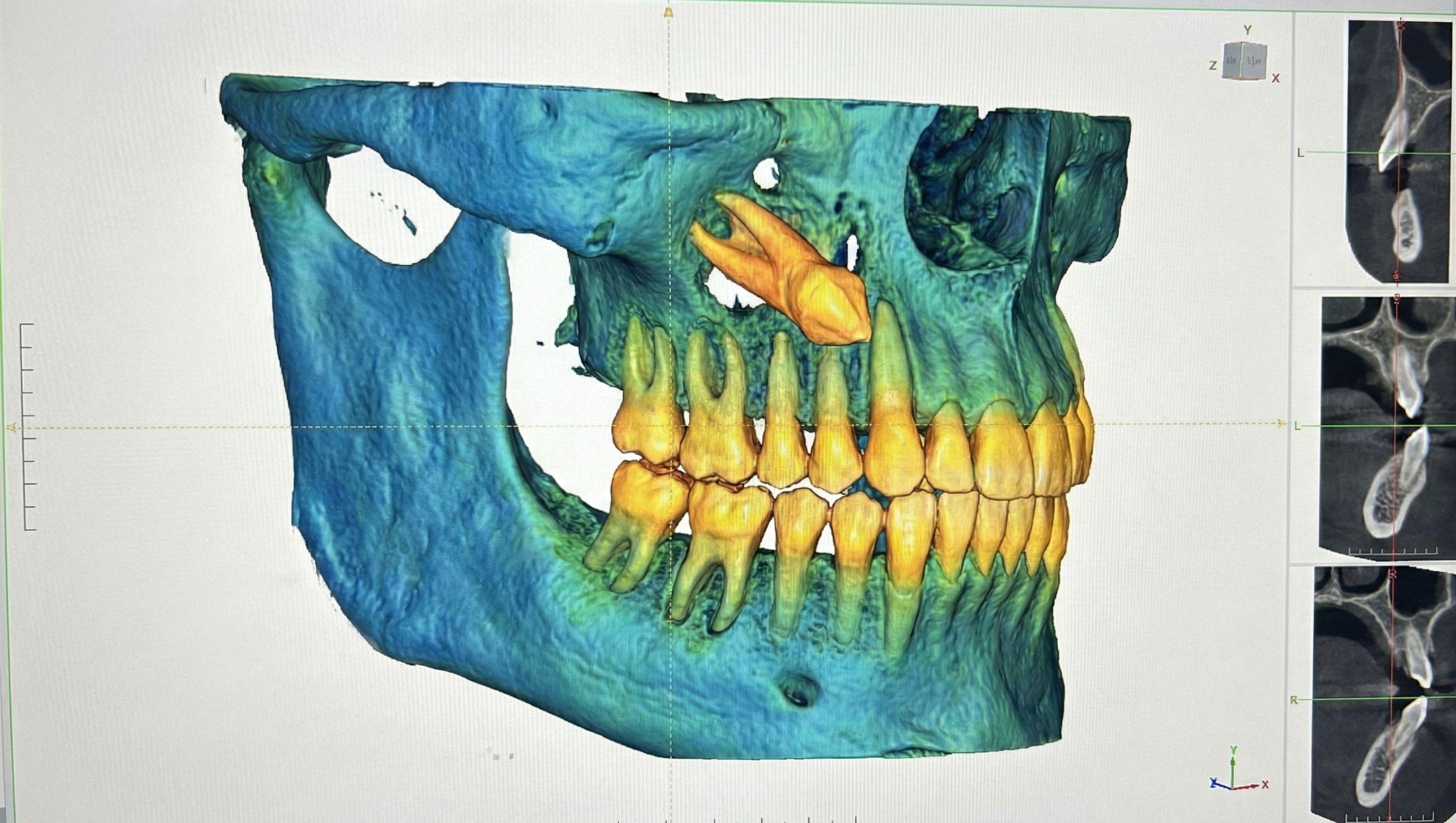 Canino Incluso nell’Adulto: Estrarlo o Recuperarlo?