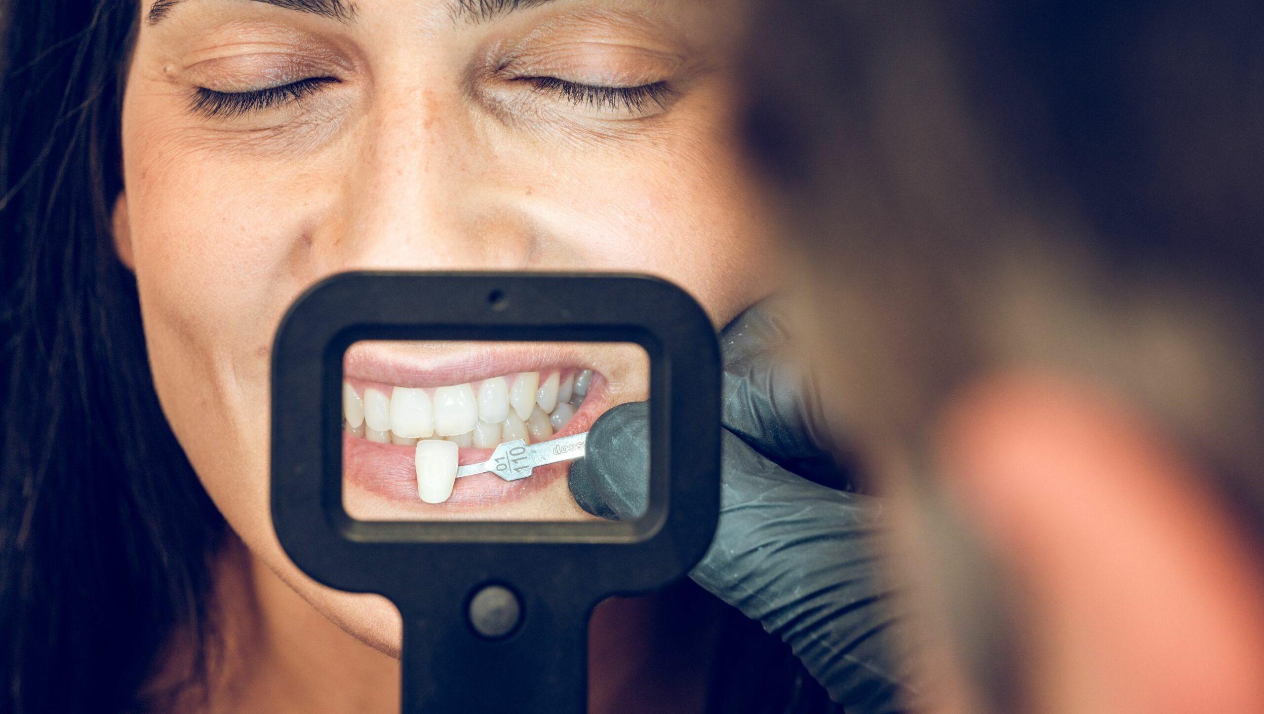 Faccette Dentali a Biella: Il segreto per il tuo Sorriso