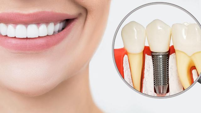 implantologia dentale