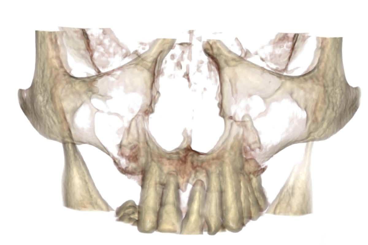 Atrofia ossea dentale