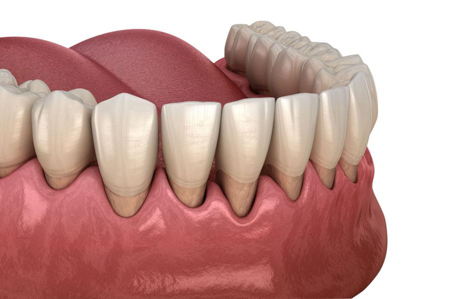 recessioni gengivali disegno