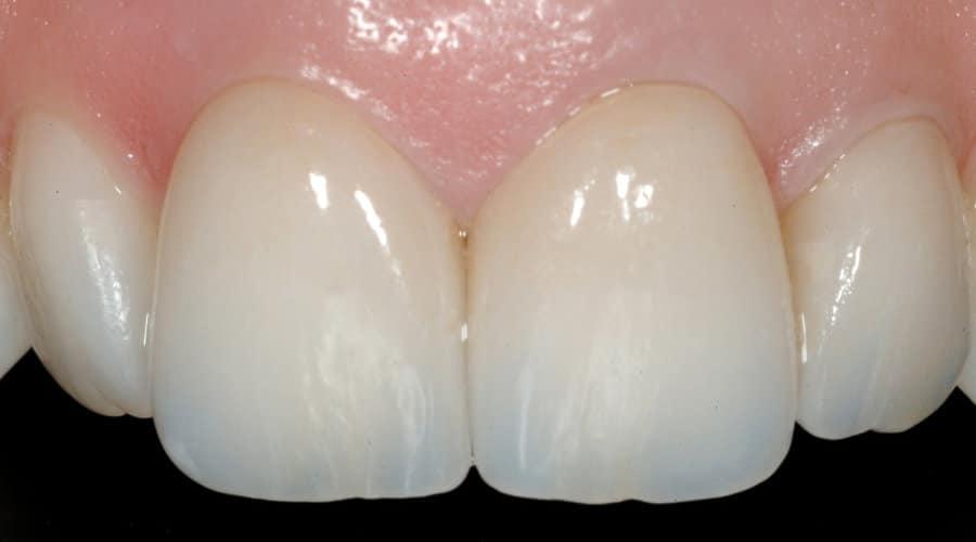 faccette dentali