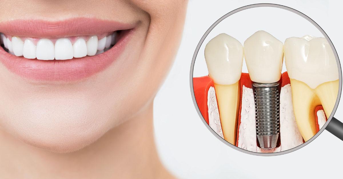 Implantologia Dentale