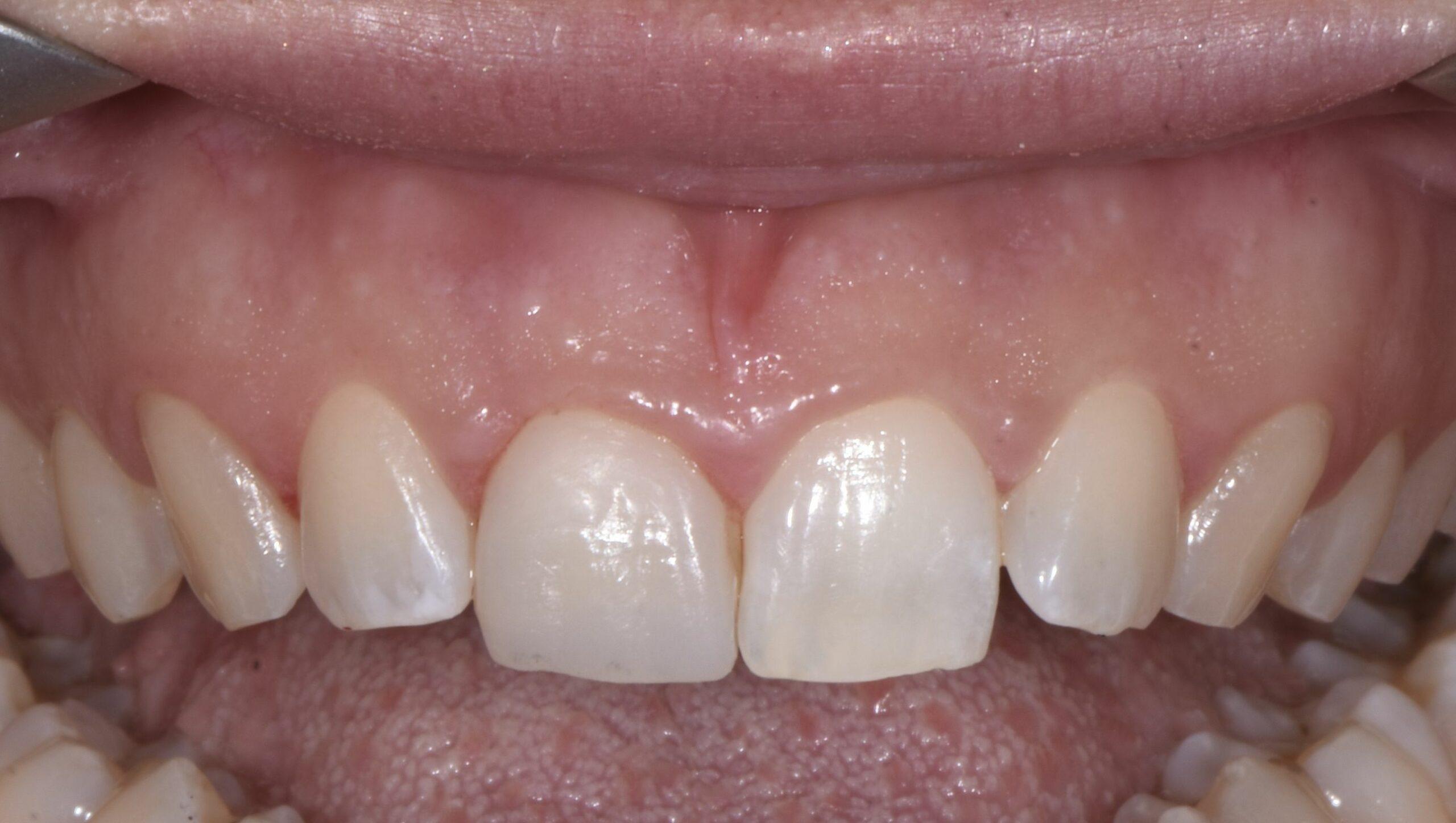 caso clinico faccette dentali paziente 10 dopo
