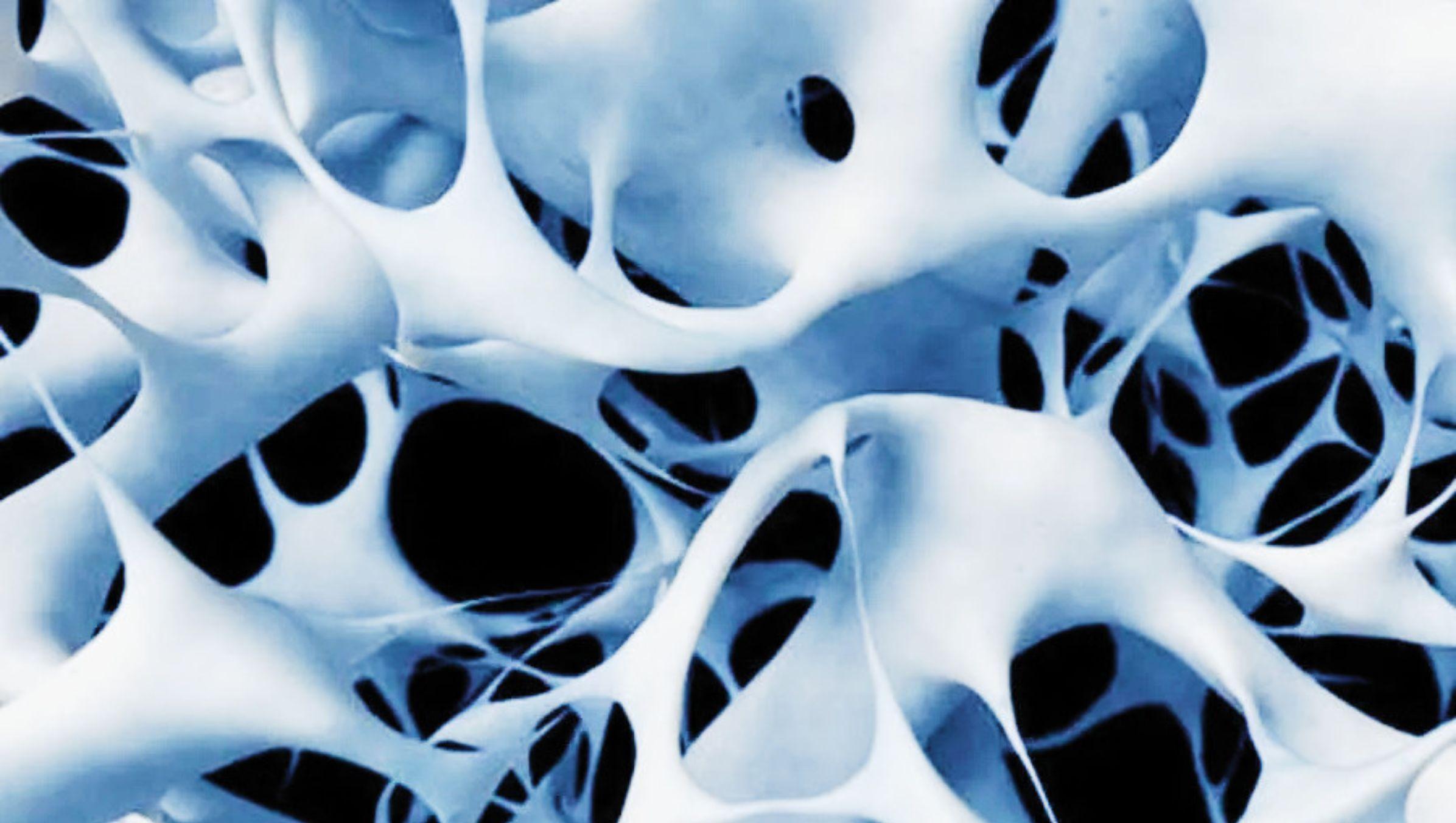 Osteoporosi e impianti dentali: si possono fare?