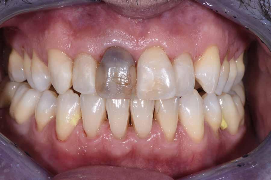 facette dentali prima dell'intervento di limatura
