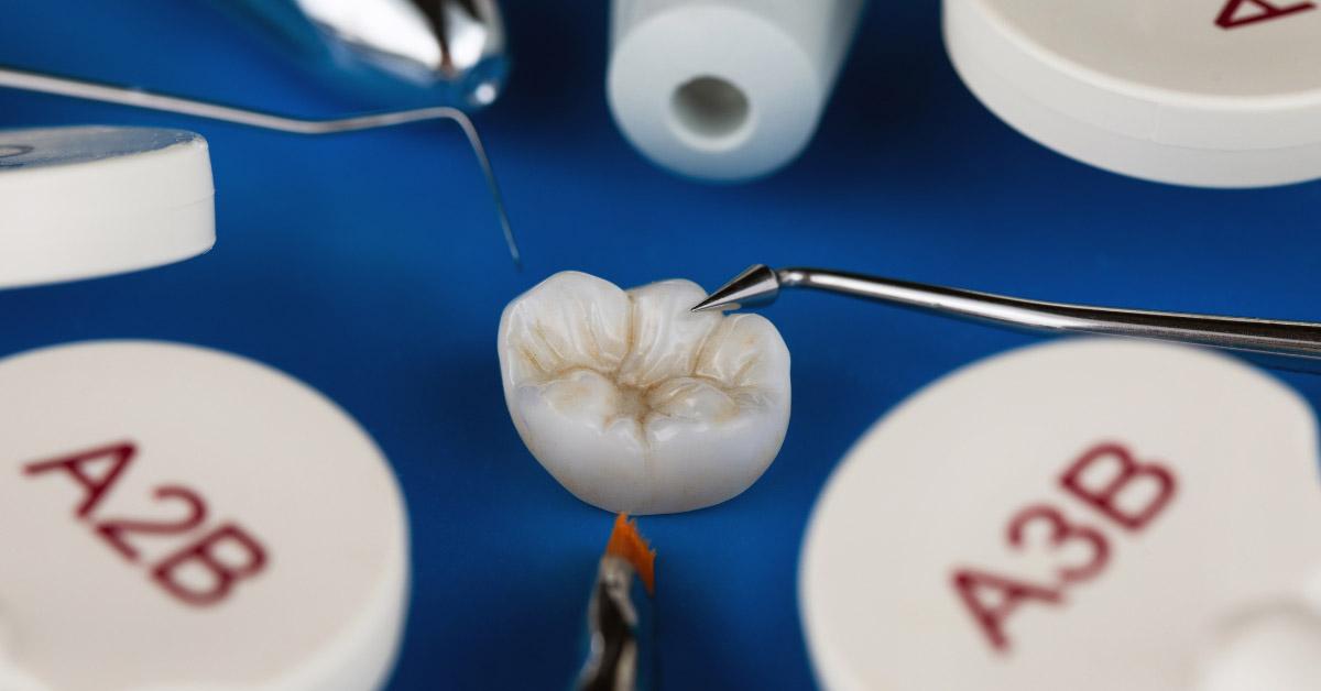 Otturazione estesa o intarsio dentale?