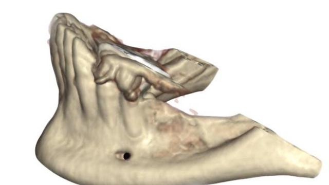 lamina corticale mandibola