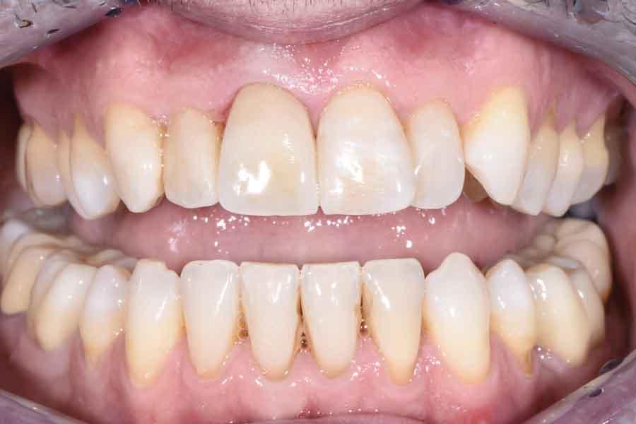 facette dentali dopo dell'intervento di limatura