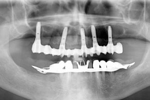 piorrea e osso scarso dopo