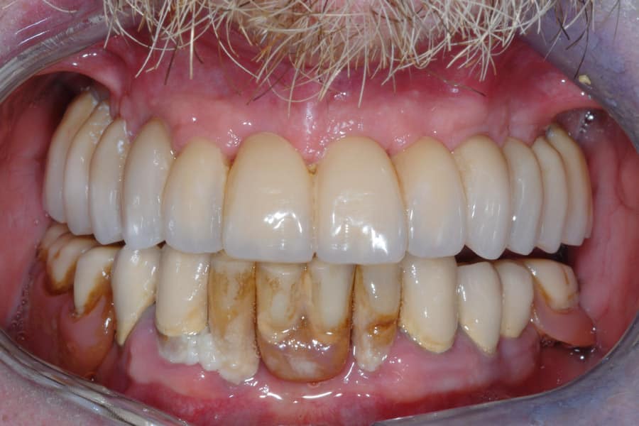 La riabilitazione protesica superiore