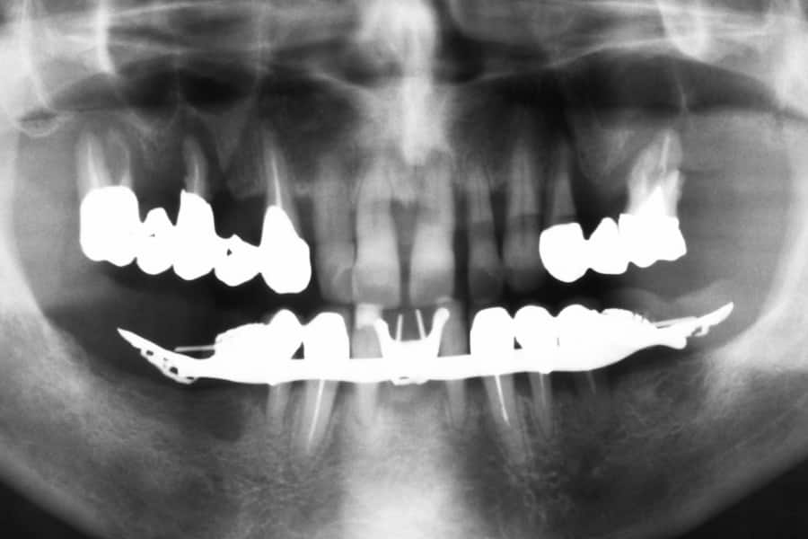 Radiografia panoramica iniziale