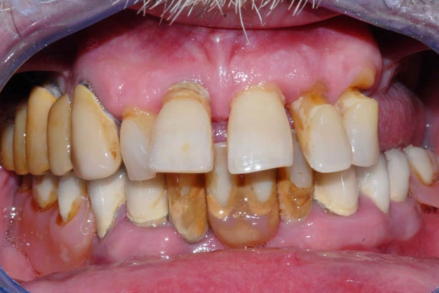 Caso iniziale prima dell'intervento di implantologia