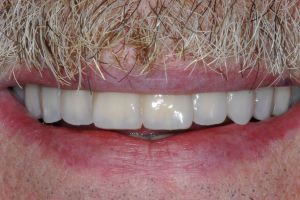 piorrea e osso scarso il paziente