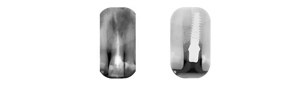Radiografie endorali prima e dopo l'impianto dentale