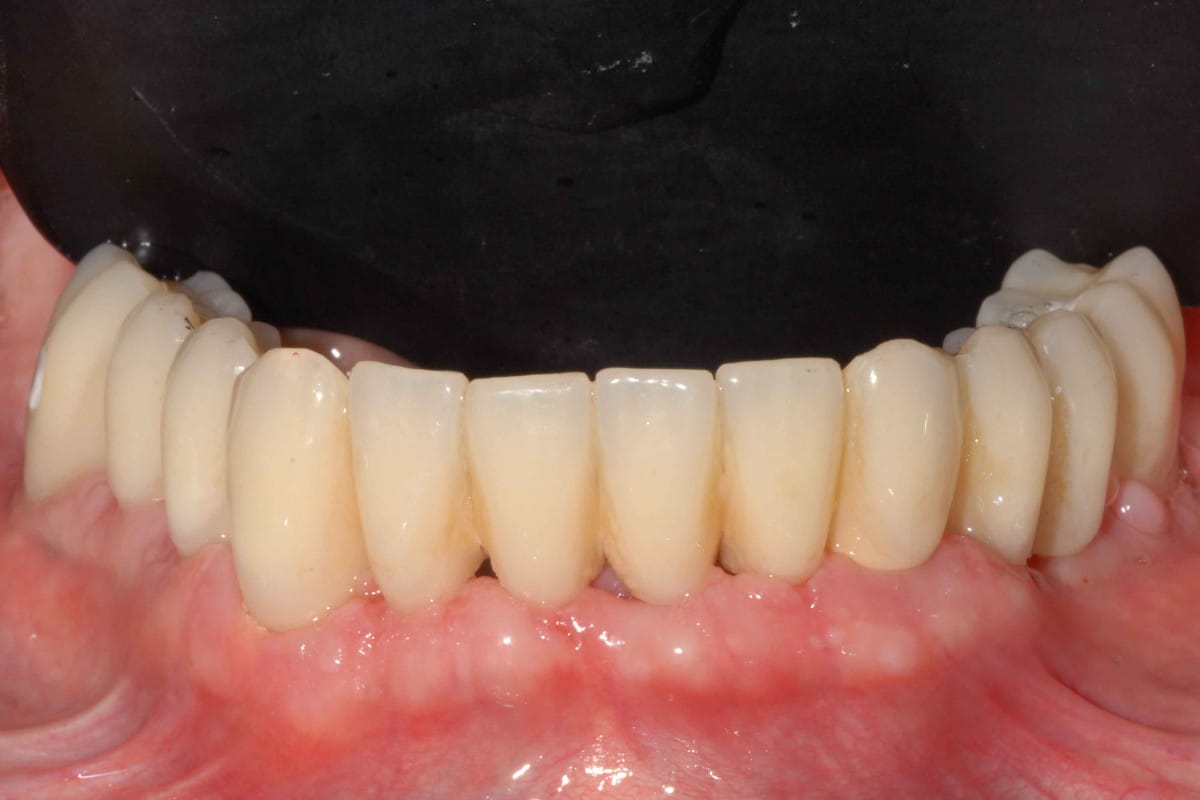 Provvisorio avvitato sugli impianti dopo 10 giorni dall’intervento con protocollo OnlyOne®.