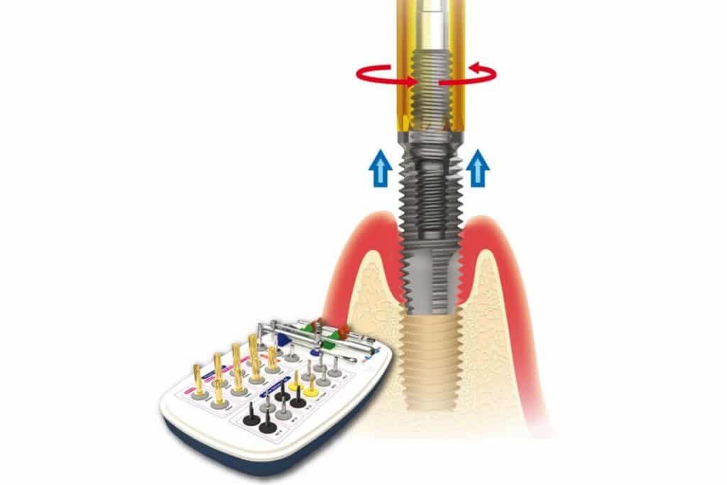 Implant Removal Kit per rimuovere gli impianti dentali