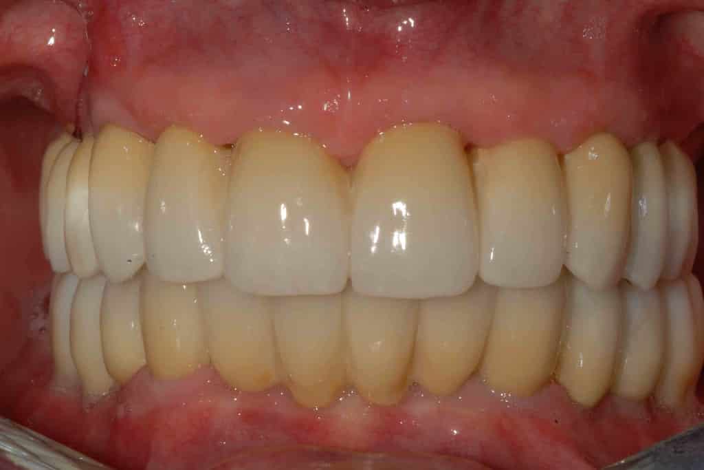 riabilitazione zirconio ceramica