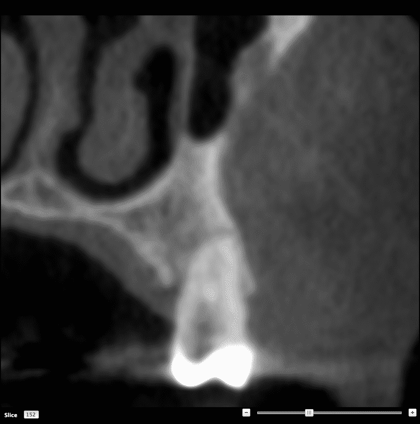 Scansione della Tac Cone Beam