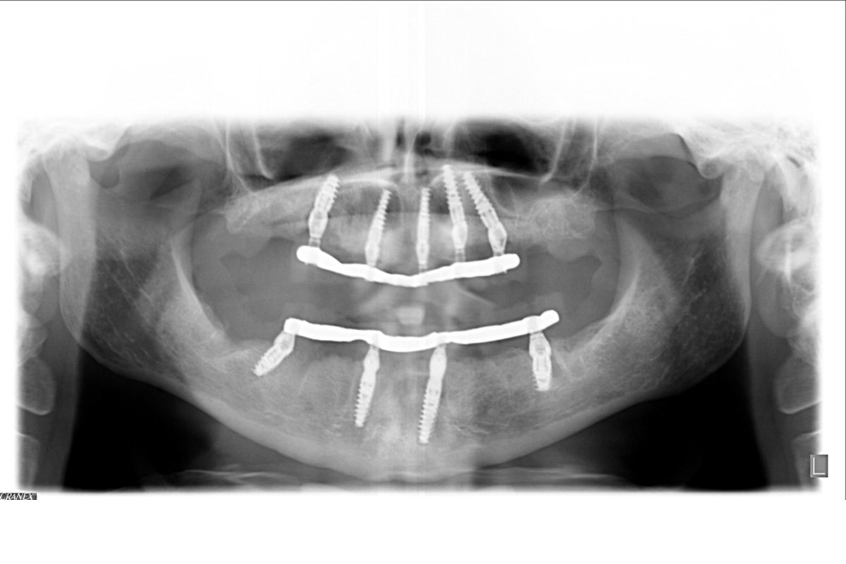 radiografia panoramica dopo l'intervento con impianti inseriti in arcata inferiore e superiore
