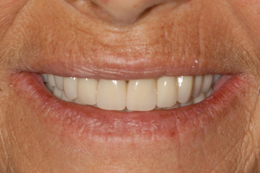 sprriso del paziente dopo l'intervento di implantologia dentale