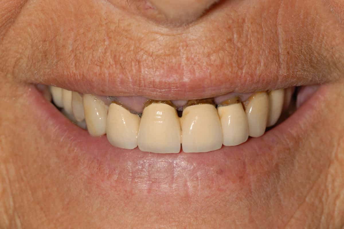 sorriso del paziente prima dell'intervento caso iniziale