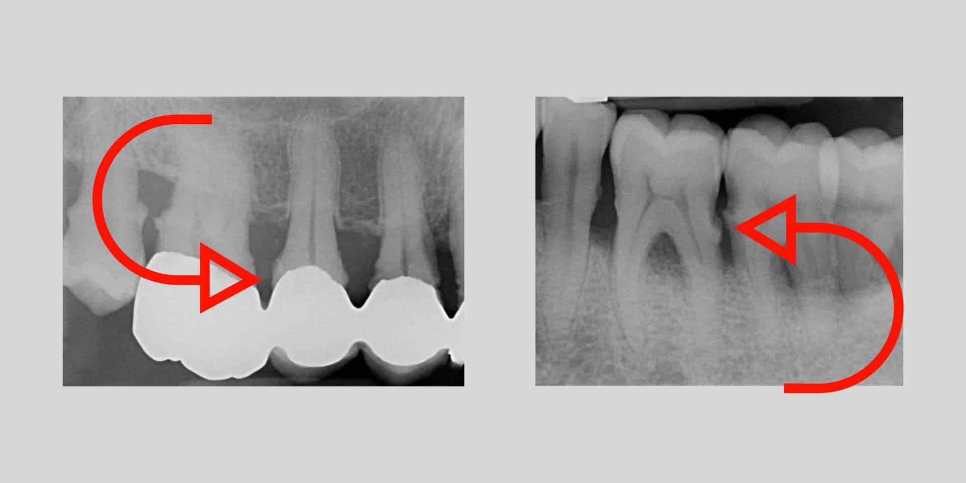 Radiografia dove si vede il tartaro