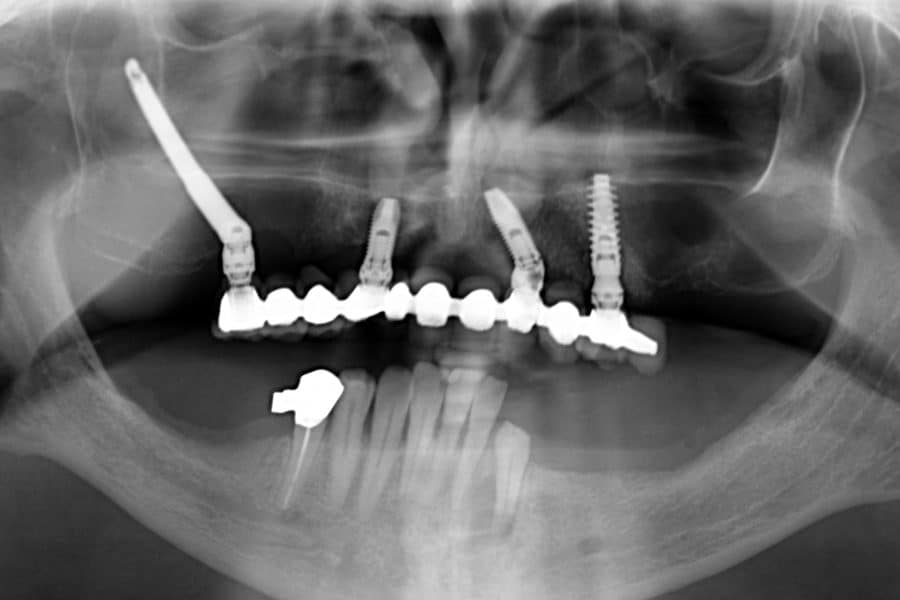 Radiografia panoramica di una riabilitazione protesica con un impianto zigomatico