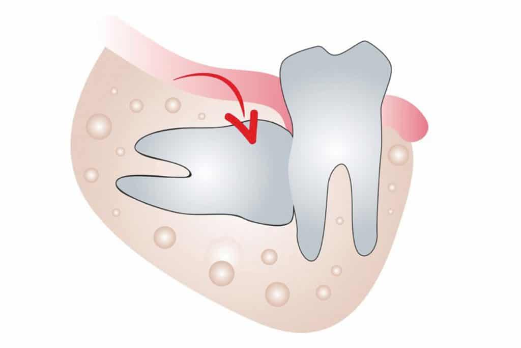 Dente del giudizio incluso orizzontale.