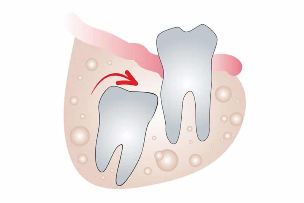 Dente del giudizio incluso.