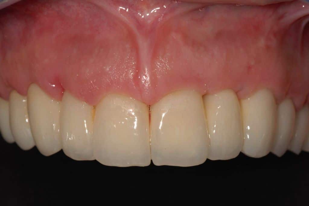 Gengiva naturale. Denti dopo l'intervento