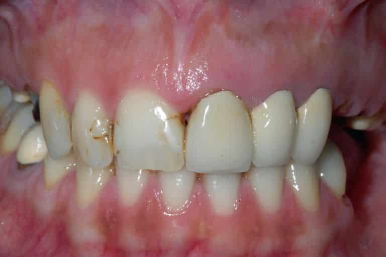 Implantologia estetica su gengiva naturale Clinica Villa