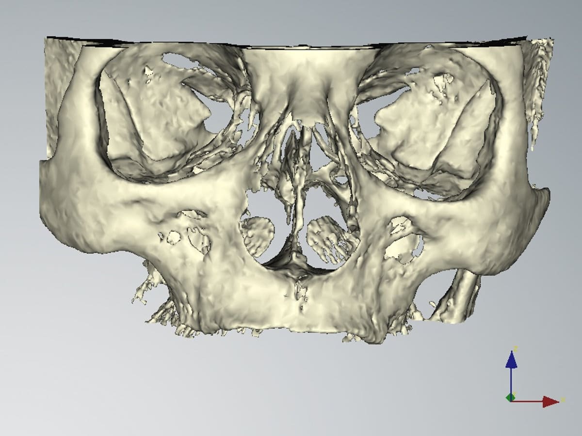 Ricostruzione 3D del cranio del paziente