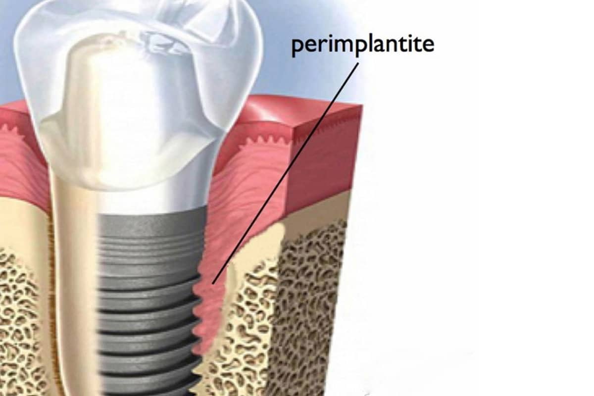 Impianto con riassorbimento osseo